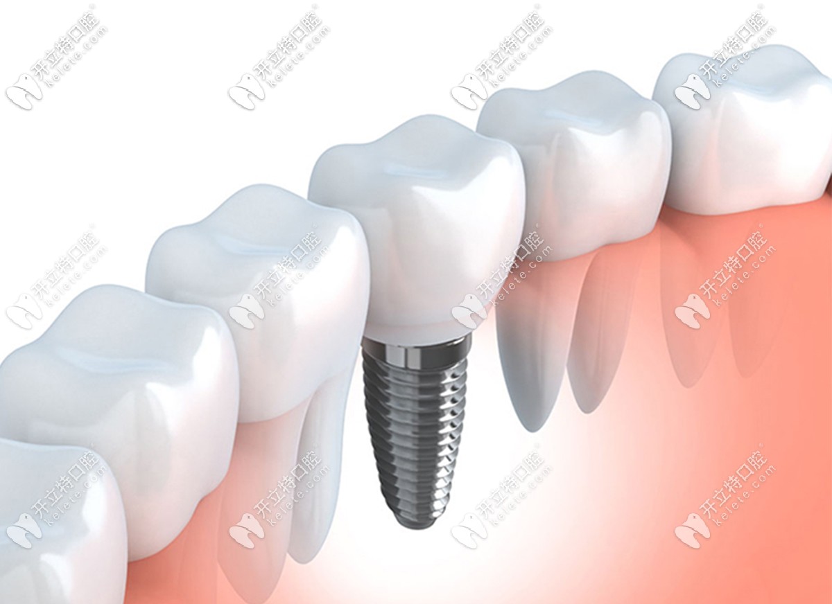 進(jìn)口種植牙