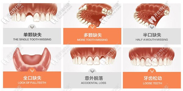 出現(xiàn)圖中六種情況需要種植牙