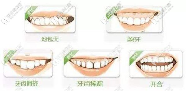 五大情況需要整牙