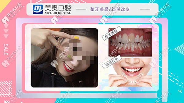 昆明美奧做矯正牙齒怎么樣?時代天使全隱形牙套收費太劃算