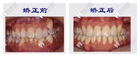 矯正前后對(duì)比