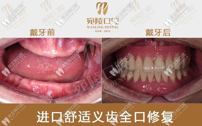 宛陵口腔全口吸附義齒對比圖