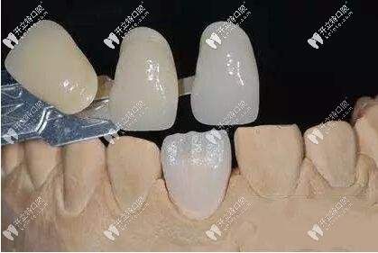 牙齒顏色對(duì)比