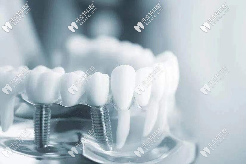 種植牙的費用情況