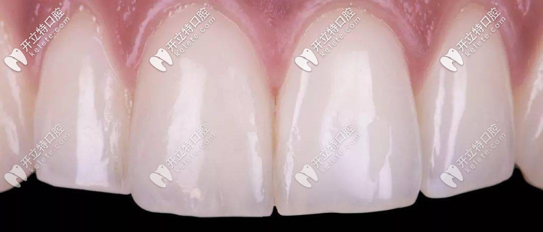 樹脂修復(fù)門牙