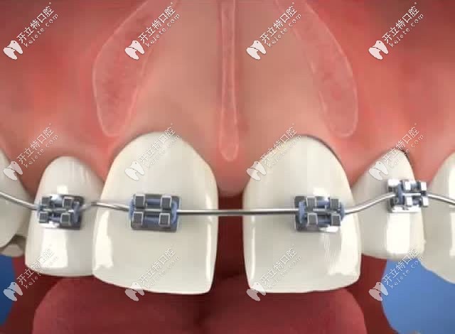 牙齒矯正修復(fù)牙縫