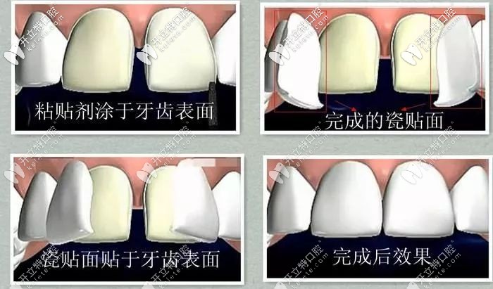 牙齒貼片修復(fù)牙縫