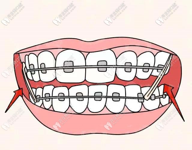 托槽矯正器的價格展示