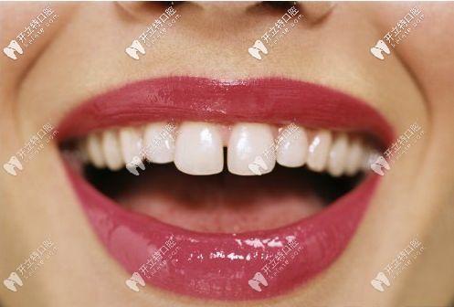 成年人門牙牙縫大怎么修復(fù)好？去做矯正還是貼面