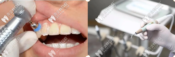 潔牙、牙修復等立減價格