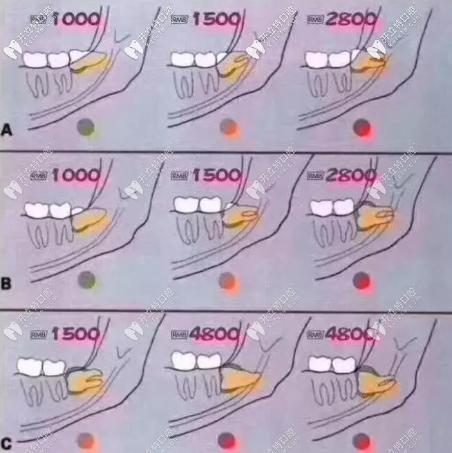 下頜水平阻生智齒價格表