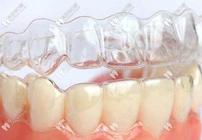 隱形矯正器的價格