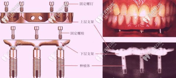 種植體的組成部分