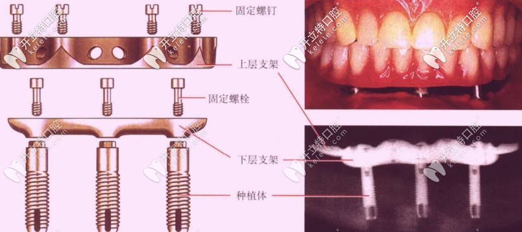 即刻負重種植牙靠譜嗎？和常規(guī)種植牙相比哪個好？