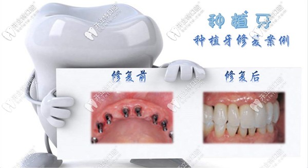 種植牙前后對比圖