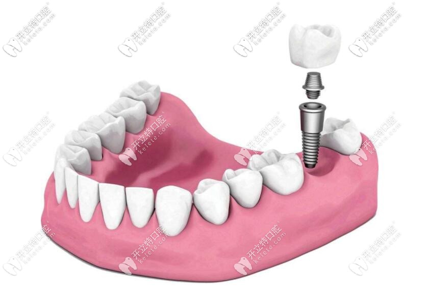 種植牙過程示意圖