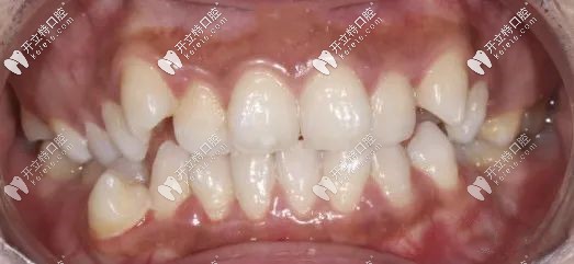 矯正前的牙齒圖
