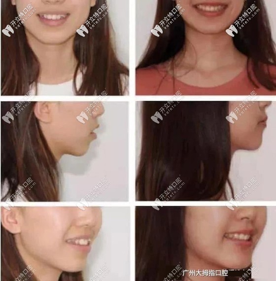 戴了60副隱適美牙套矯正虎牙后的效果