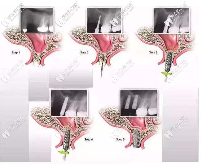常用的骨增量技術(shù) 常用的骨增量技術(shù)