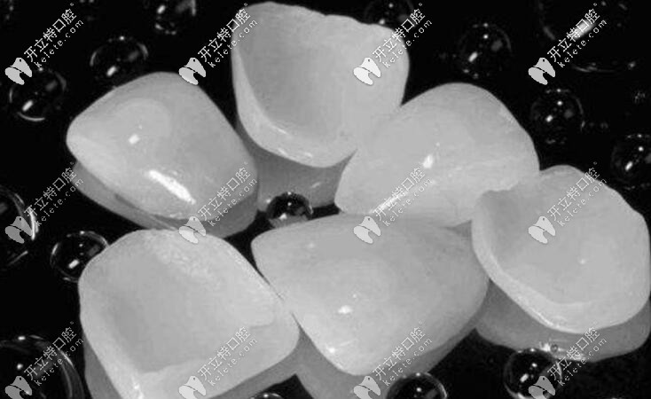 超薄牙齒貼面圖片