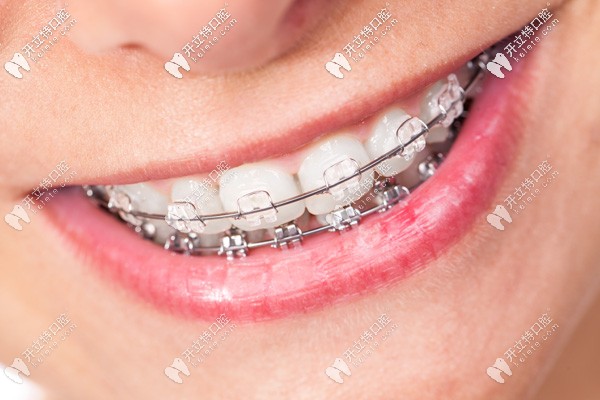 廣州增城區(qū)陶瓷牙套矯正