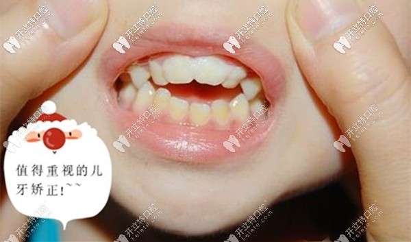 增城區(qū)兒童牙齒矯正參考價格