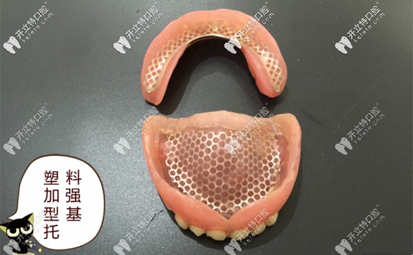 金屬網(wǎng)加強塑料基托