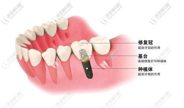種植牙示意圖 種植牙示意圖