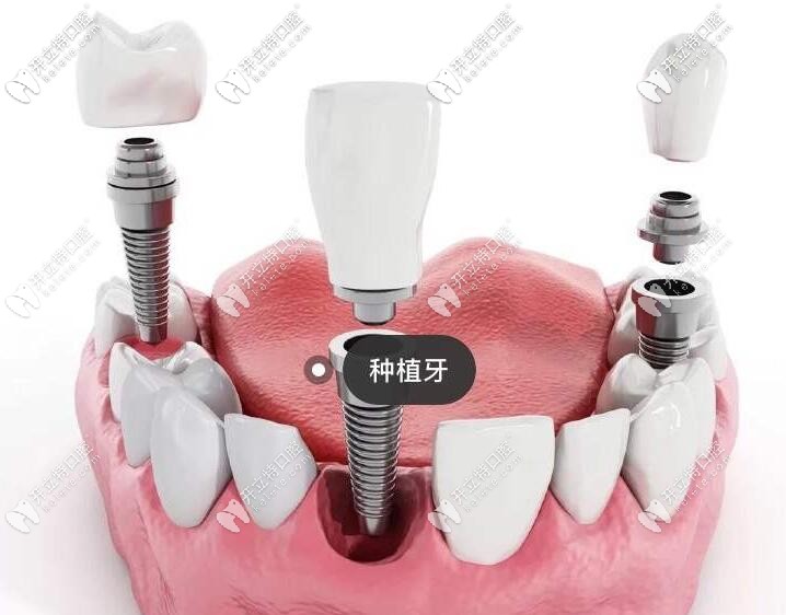 牙齒種植
