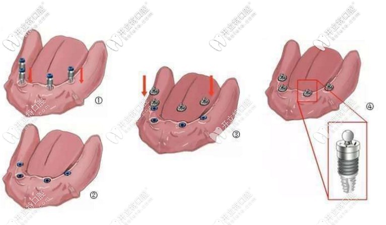 球帽覆蓋義齒種植過程 球帽覆蓋義齒種植過程