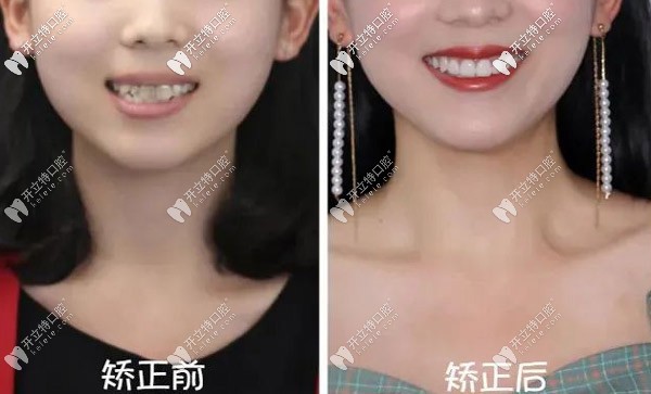 哇~22歲重度齙牙的我做了正雅日夜版隱形矯正竟然逆襲！