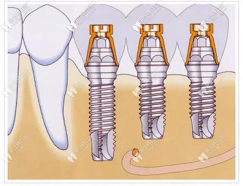 做種植牙靠譜的醫(yī)院