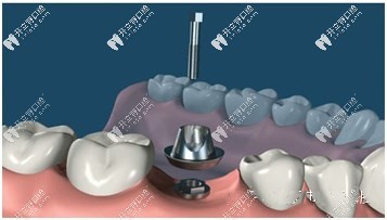 種植牙構造