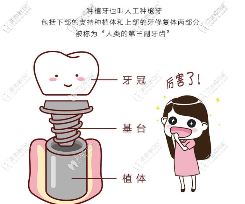 種植牙介紹 種植牙介紹