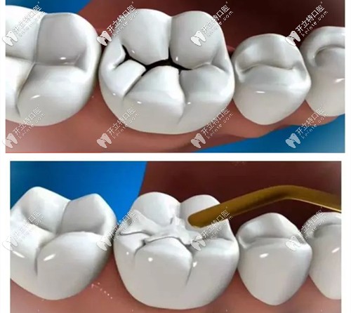 補(bǔ)牙材料不同收費(fèi)也不同 補(bǔ)牙材料不同收費(fèi)也不同