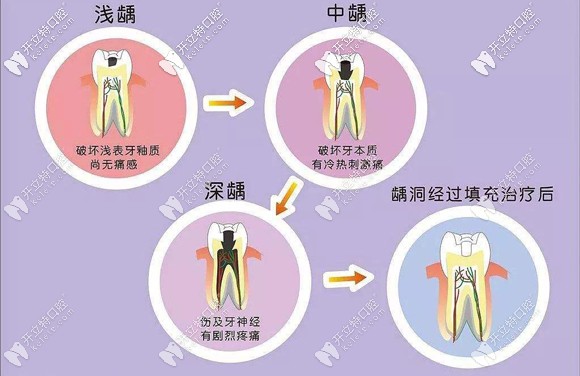 不同補(bǔ)牙技術(shù)也決定了補(bǔ)牙的收費(fèi) 不同補(bǔ)牙技術(shù)也決定了補(bǔ)牙的收費(fèi)