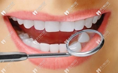 牙齒美白 牙齒美白