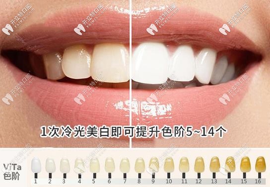 冷光美白色度選擇