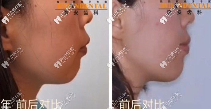 看呆！凸嘴少女在惠安齒科戴自鎖托槽矯正半年后…