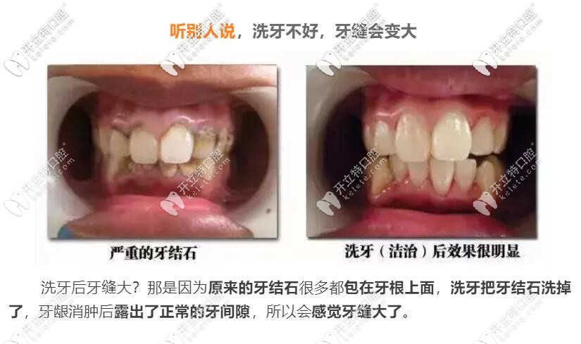 洗牙牙縫會(huì)變大嗎 洗牙牙縫會(huì)變大嗎