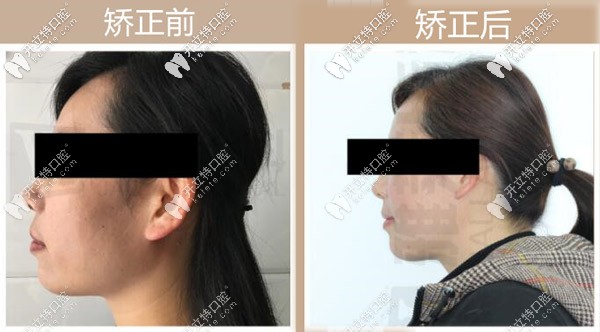 側(cè)臉突出矯正前后