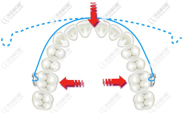 口腔正畸弓絲的種類及性能