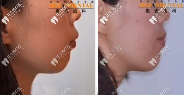 通過矯正可能獲得一個(gè)下巴哦