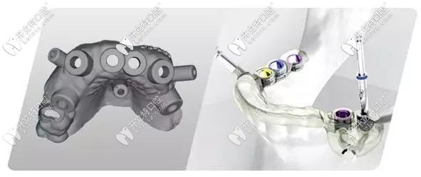 南寧悅美口腔數(shù)字化導航種植牙