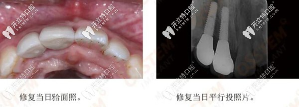 前牙美學(xué)區(qū)種植牙效果