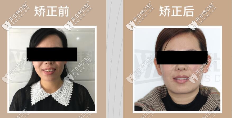 牙齒突出前后對(duì)比圖