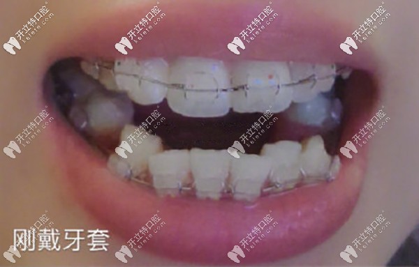 齙牙矯正剛戴牙套