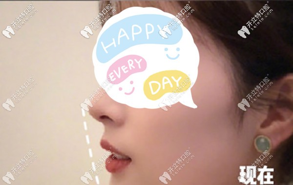 齙牙矯正后的側(cè)顏