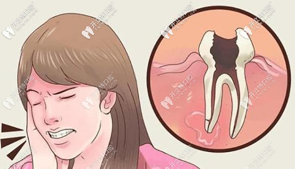 補(bǔ)牙洞疼不疼?超詳細(xì)的補(bǔ)牙過程來了解下