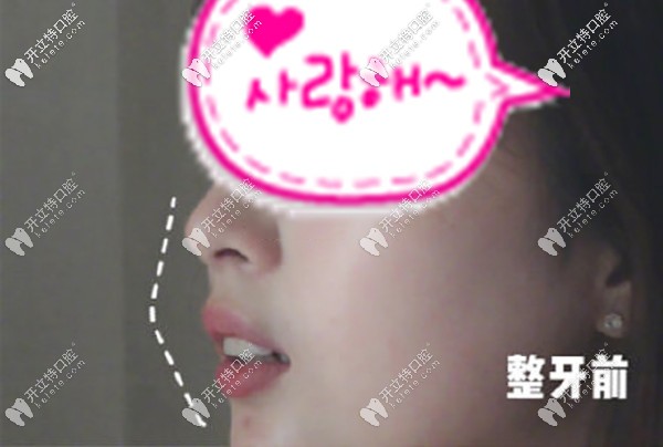 西安牙友反饋在美奧口腔做深覆合齙牙糾正后，側(cè)顏絕了